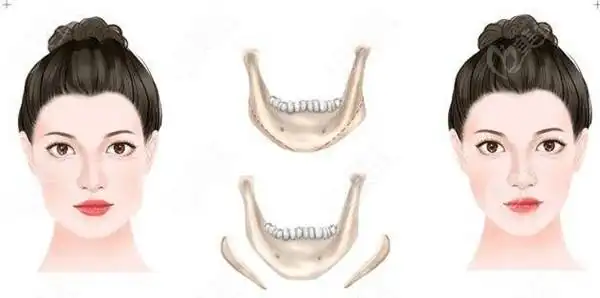 下颌角削骨十年了脸型挺好看,没出现3,5年脸下垂塌陷的情况