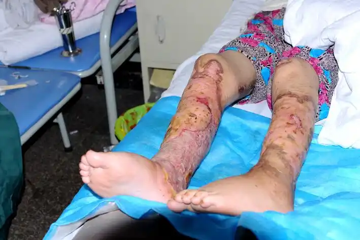 增产乡三清村19岁少女徐金凤双腿严重烧伤,期待您的爱心救助