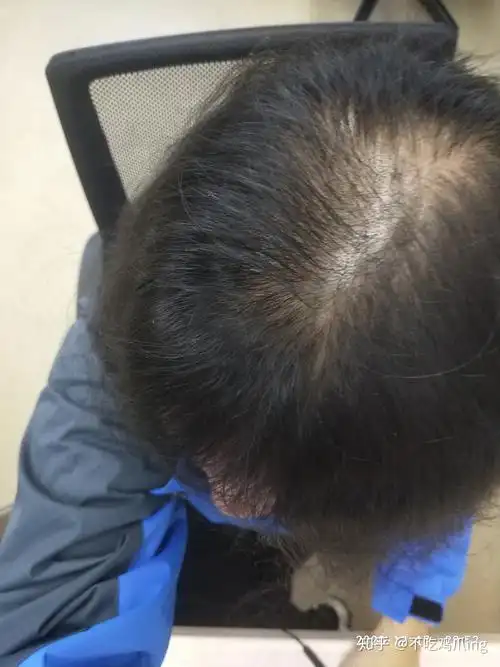 女生脂溢性脱发治疗过程记录2