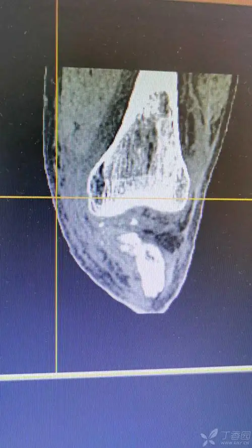 胫骨髁间棘合并后交叉止点撕脱骨折,请教如何处理?