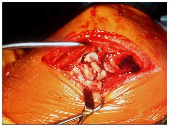 remove hematoma and irrigate.   切开环状韧带显露桡骨