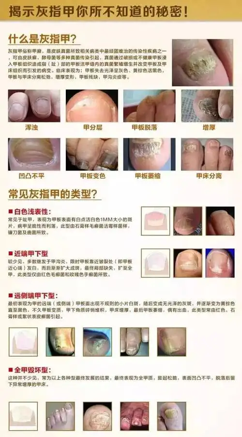 得了灰指甲,一个传染俩.你的指甲还好嘛?速度阻止一个传染俩的悲剧!