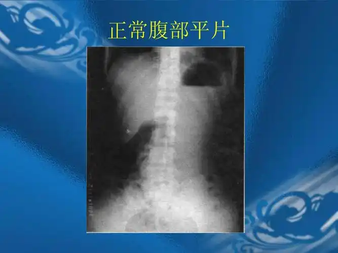 正常腹部平片