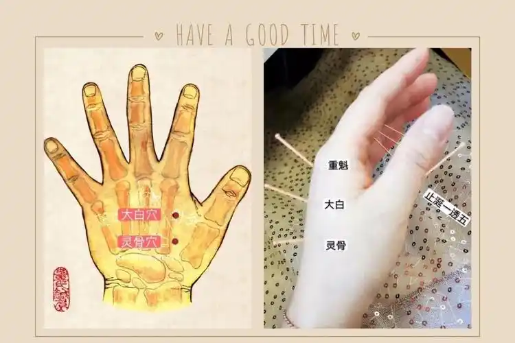 董氏针灸面瘫处方