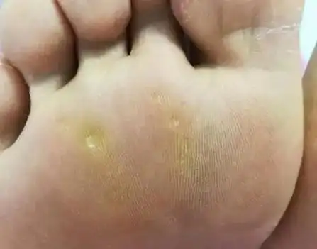 脚底长了像鸡眼一样的东西是什么,脚底长鸡眼或胼胝怎么办 - 玉三网