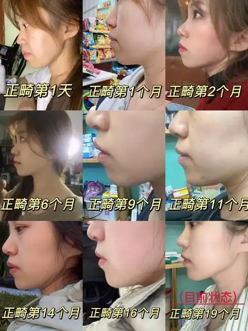 地包天牙齿正畸第22个月(对比合集)