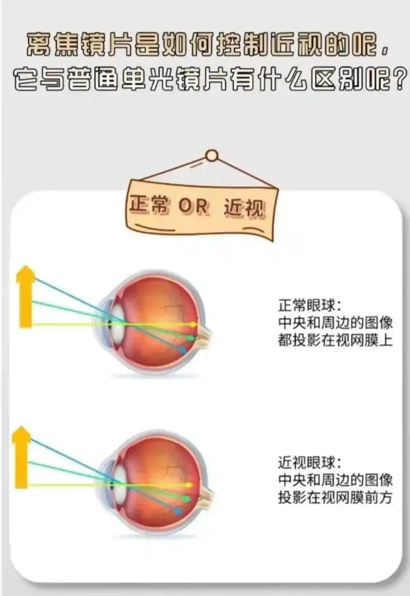 单焦镜片与离焦视力缓控镜片的区别.正常眼球 与 近视眼球 正 - 抖音