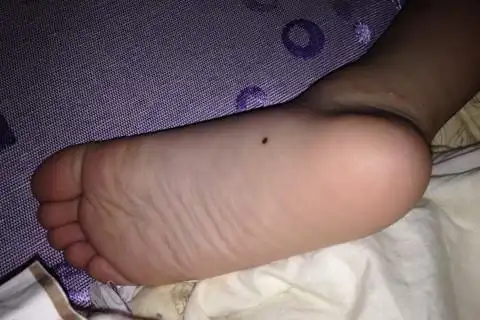 脚底有痣的男人命运还是相当不错的,日后的生活也会顺风顺水,遇见的好