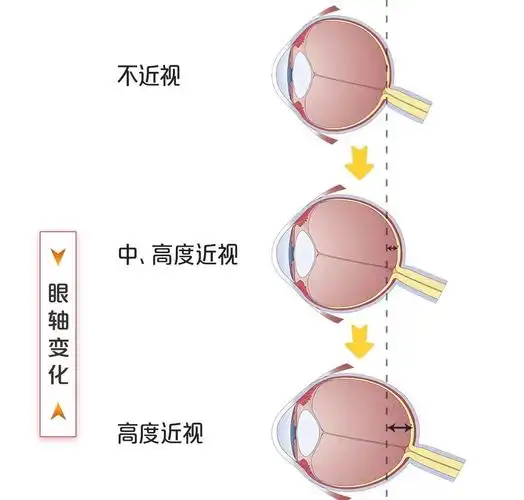 轴性近视人群每增长300度,眼轴增长1mm,简单来说,眼球凸出是度数增长