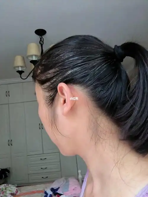 38岁两鬓白发特别多怎么办