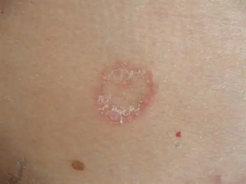 花斑癣会不会传染,预防治愈双管齐下