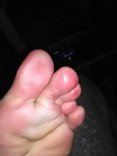 脚板底发红发肿,有点像烧伤一样痛,今天上午轻微痛,下午痛的几乎不能