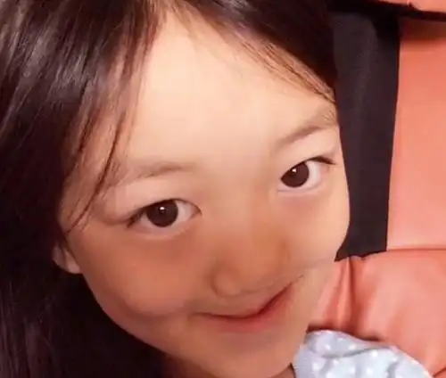 小嫣然是在美国接受的手术治疗,也就是通常所说的唇腭裂修补术.