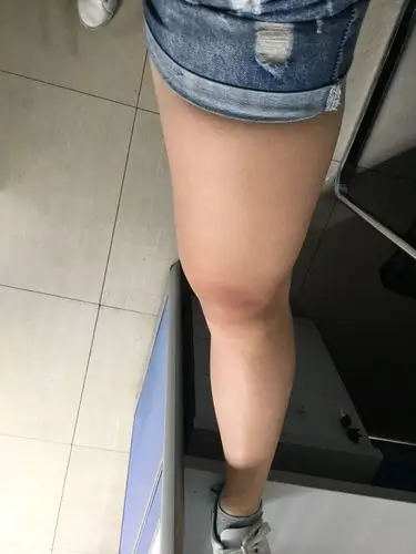 大腿靠膝盖外侧肉突出,有肌肉有脂肪,想知道减脂后能不能解决线条问题