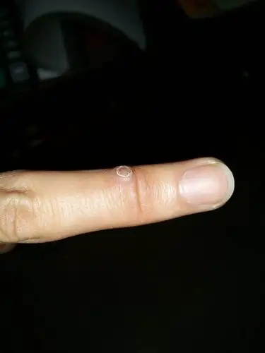 手上起了一个疙瘩,一开始很小,这一年了