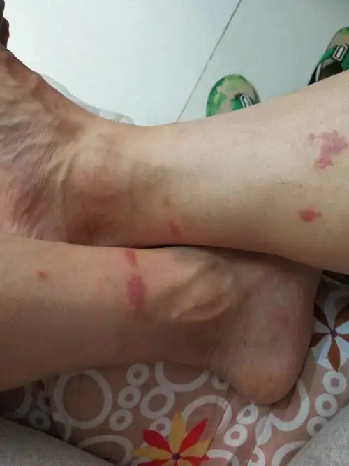 被狗跳蚤咬了之后变成红色一片,请问吃些什么药