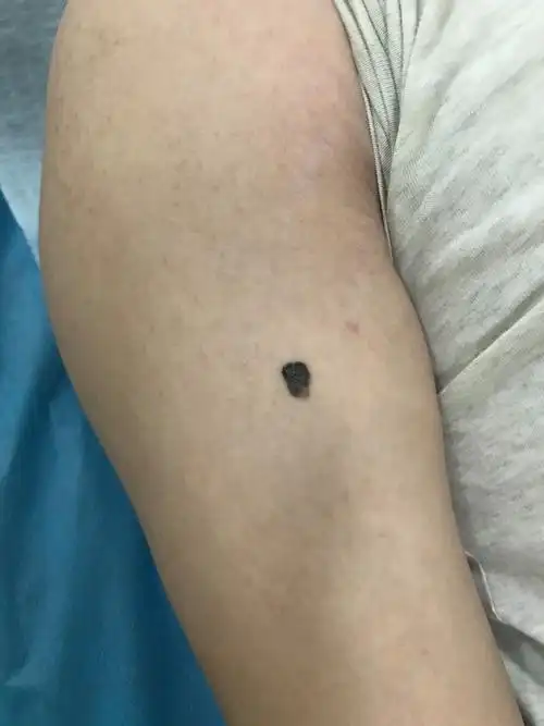 好声音亚军张恒远因黑色素瘤离去,不少年轻人慌忙赶去皮肤科:"快帮我