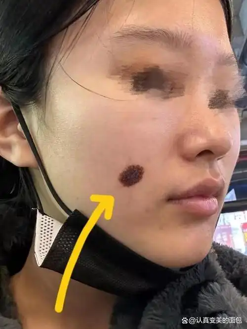 黑色素痣如何去除根治?