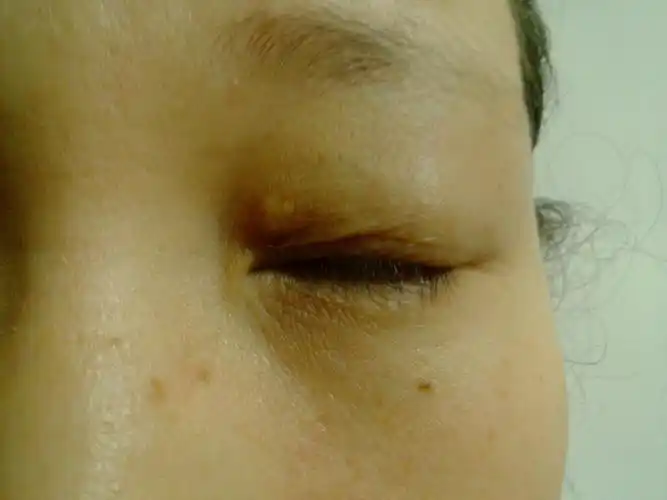 生完孩子后,月子内左眼上眼皮接近内眼角的位置先后长了四个小米粒
