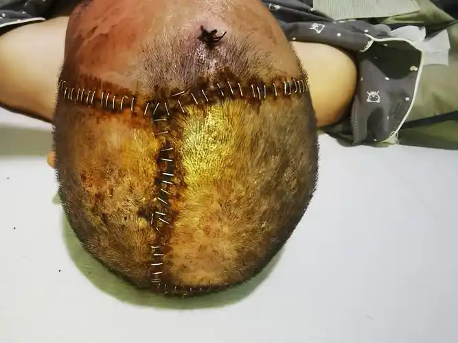 头皮钝挫伤预后不佳再次切开缝合病例1例