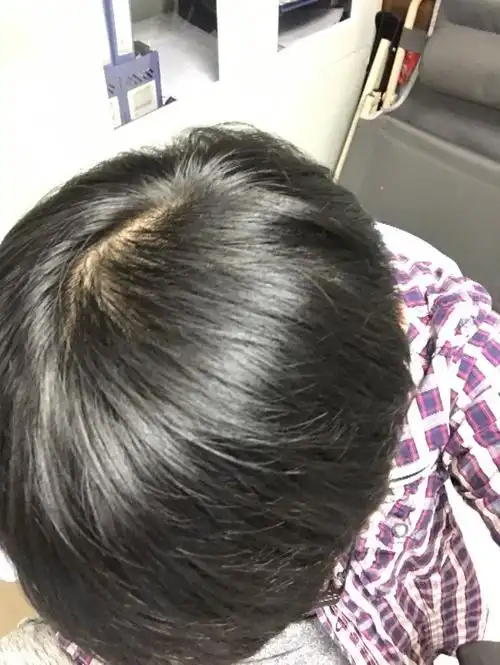 头顶发量正常吗(洗澡的时候掉挺多头发的,平时弄头发的时候,我会掉几
