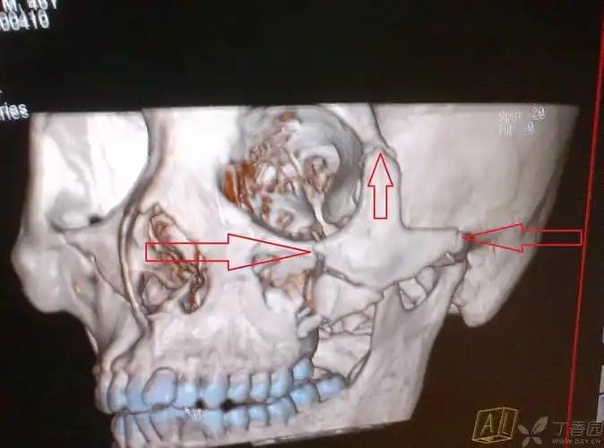 上颌骨骨折 [病例帖]