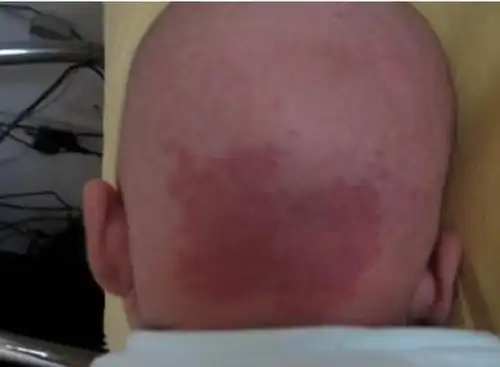 鲜红斑痣最初图片