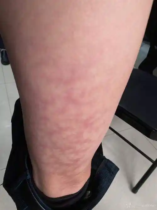 57岁男性突然出现大腿外侧花纹纹路