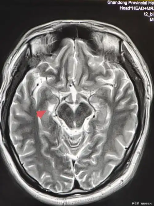 科普脉络膜裂囊肿