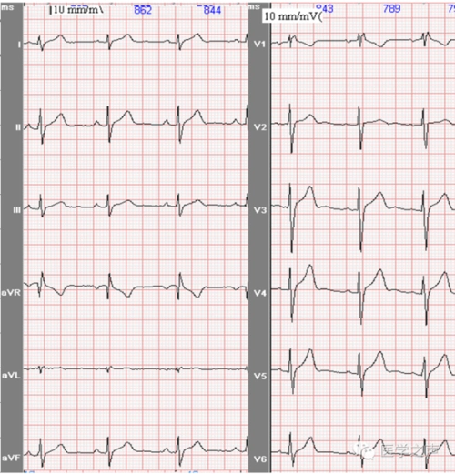 每天学看一份心电图(第29期)完全右束支传导阻滞