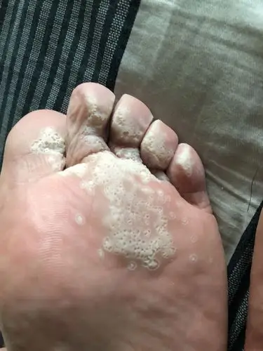 我脚上的这个是什么?怎么办?