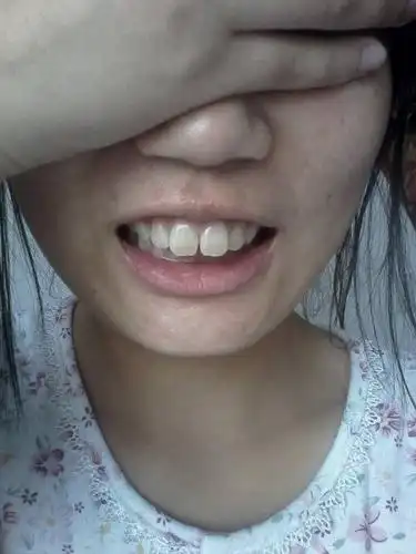 我有两颗大板牙往外突,一说话就能看见,同学们都