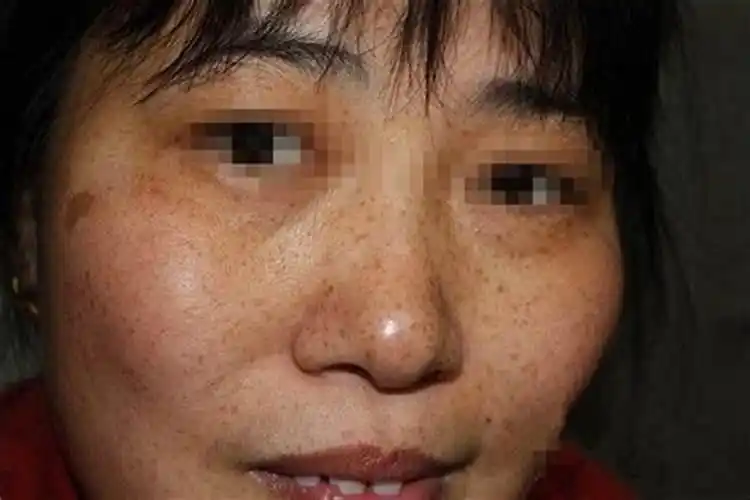 脸色暗沉发黑是什么病的前兆?脸发黑发暗是什么征兆图片