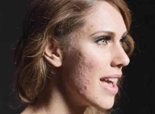 脸上毛孔堵塞的4个原因