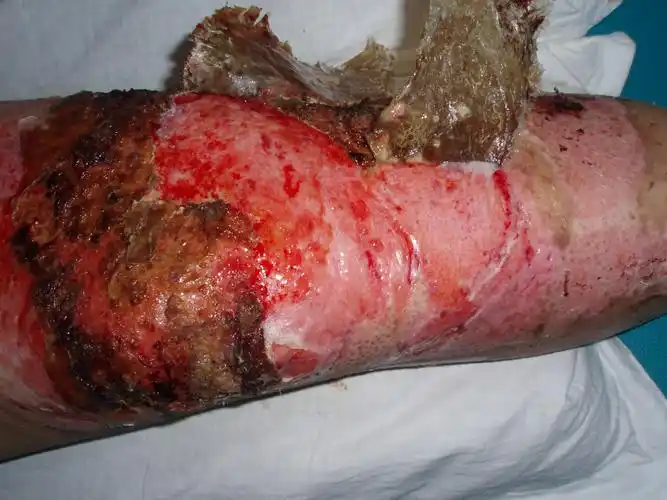 深二度烧伤的介绍