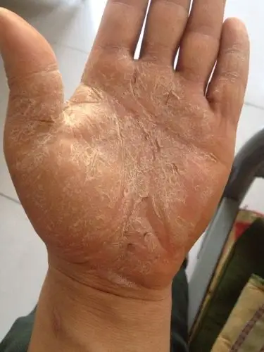 皮肤病 手掌干裂严重 治不好 有什么偏法