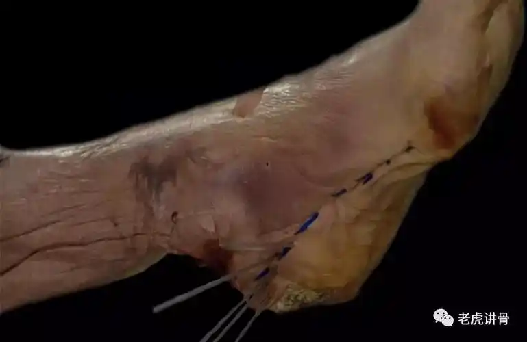 bjj:外固定时跟骨穿针的安全进针点和角度