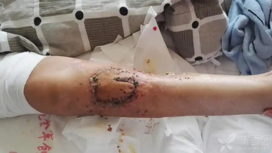 腓肠肌内侧头肌皮瓣修复胫骨中上段骨外露