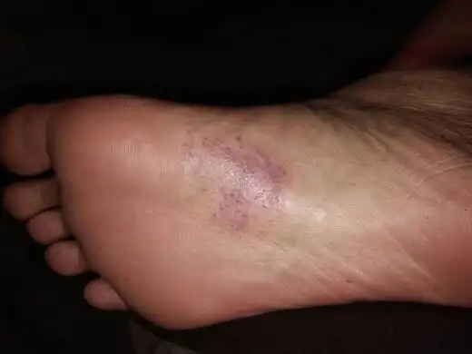 脚底板.红.小颗小颗的.痒.什么病.看图.该用什么药