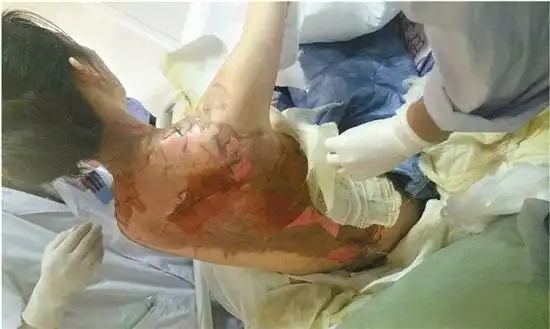 受害人林女士全身25%被烫伤,惨不忍睹.资料图片