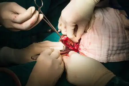 结扎附录阑尾切除术照片