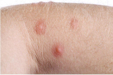 银屑病的早期症状