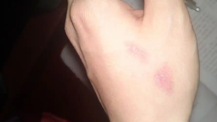 手烫伤了,如图,会留疤吗.如何护理.