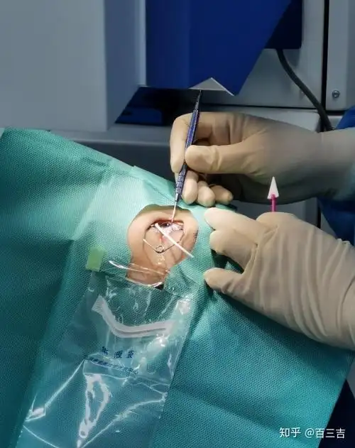 近视眼手术1个月我后悔了吗