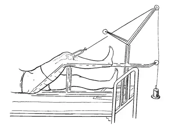 胫骨结节牵引术