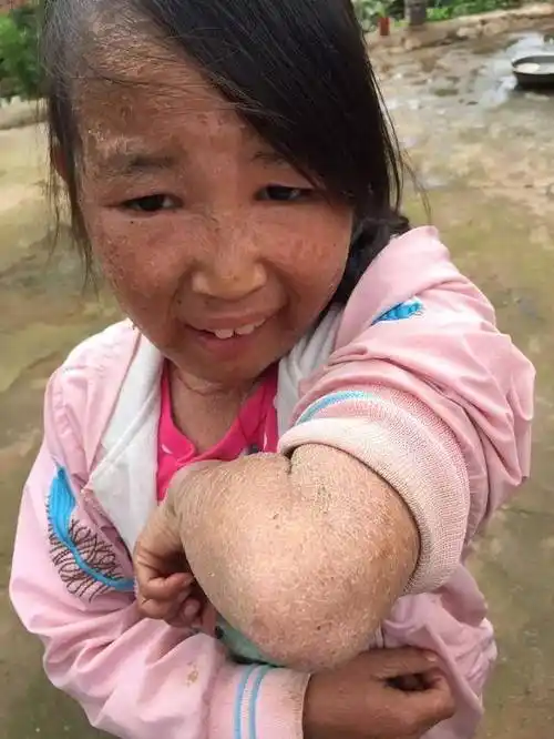 经过鱼鳞病权威专家张院长的亲自问诊和检查,确诊小何为板层型 红皮