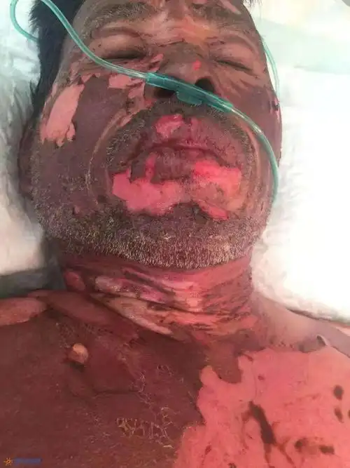 家中顶梁柱被煤气炸伤严重,急需救助!