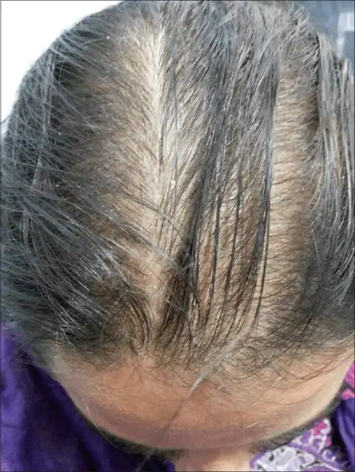 女性症状较轻,多头顶头发稀疏,前额发际线不后移(见下图).