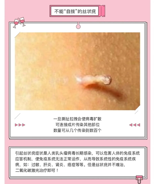 丝状疣不能自拔二氧化碳激光治疗轻松解决