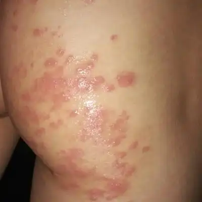 尖锐湿疣早期症状图片是什么样的